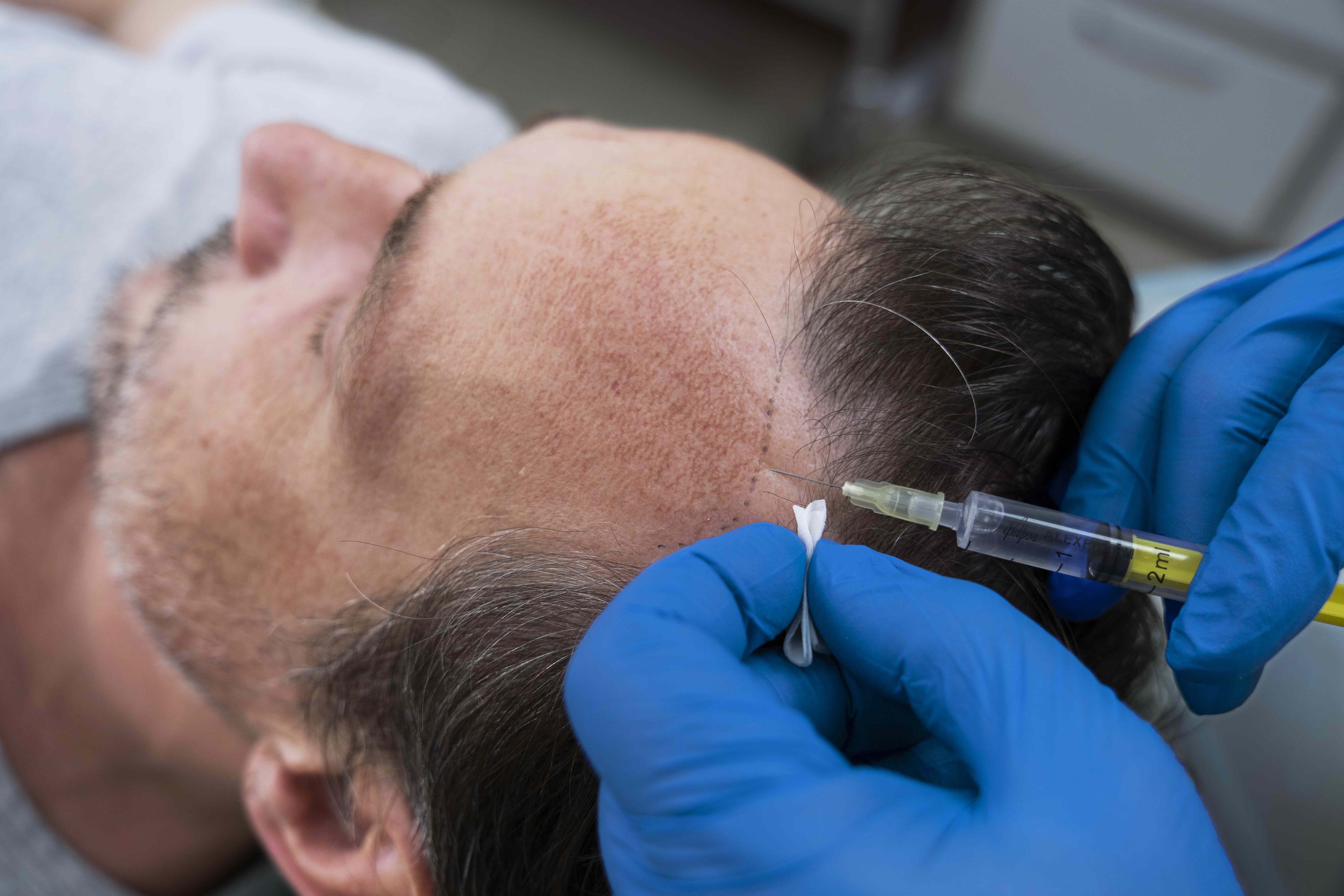 UK TVET Learning College | Hair Loss Treatment