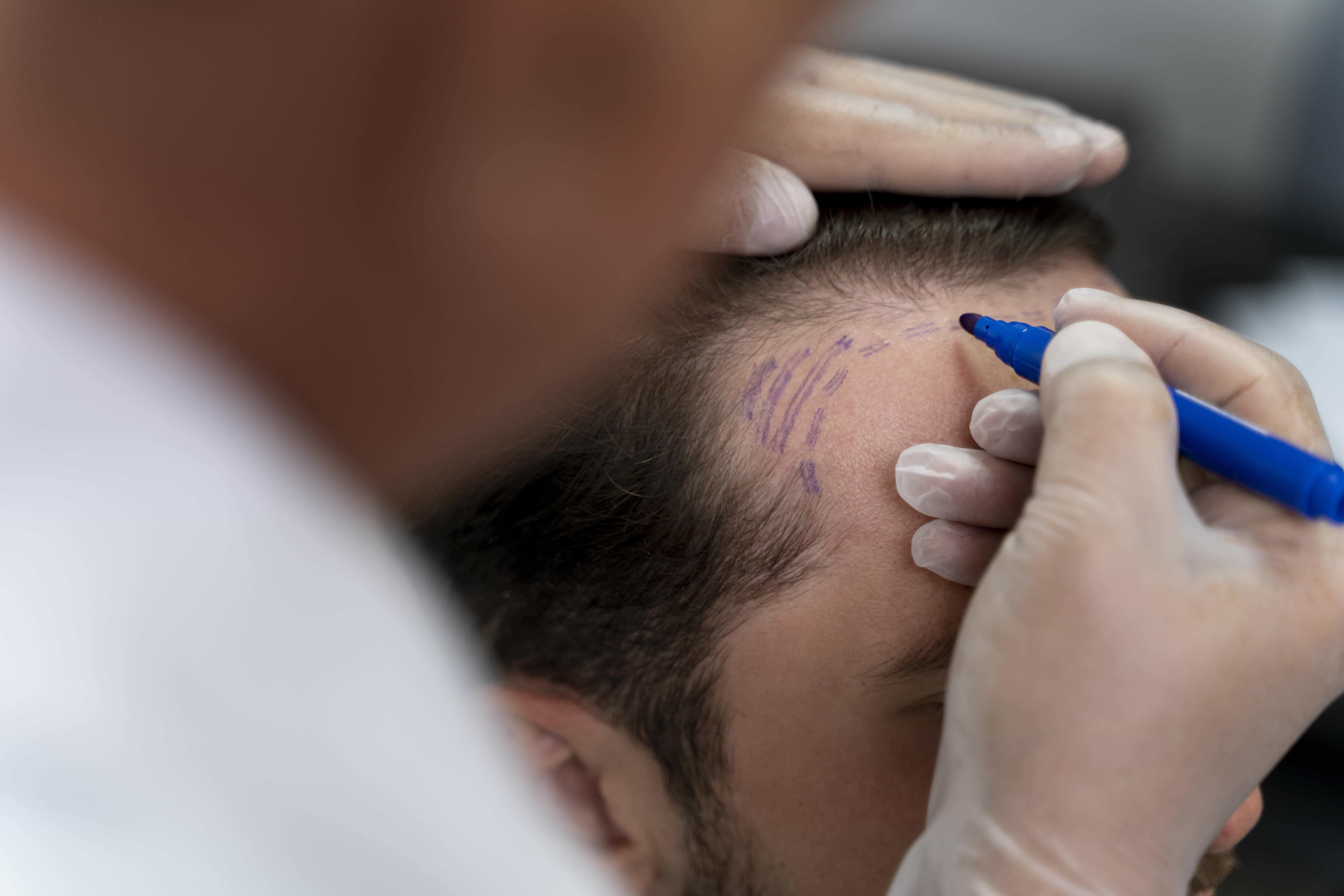 UK TVET Learning College | Hair Loss Treatment